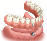 A diagram depicting the way implant-supported dentures attach to two dental implants placed towards the front of the jaw.