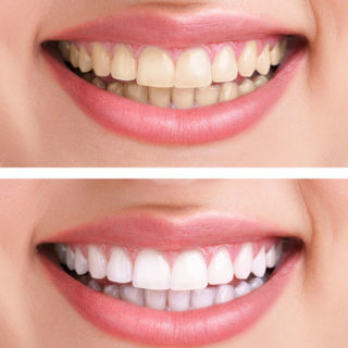 A comparison photo showing how yellow and dark teeth look before having teeth whitening, and then the brighter tooth color that results from the treatment.