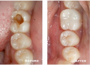 Before and after photographs placed side by side show the difference that white fillings can make. The left image shows a tooth with a large area of decay, and the right image shows the same tooth has been made whole again after placing a composite filling.