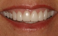 A close up of the same smile after receiving brand-new porcelain dental crowns. Dental implants look much better when crowned by a skilled cosmetic dentist.