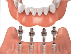 Image of implant overdentures