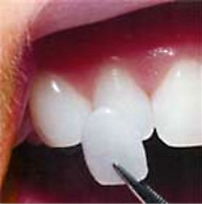 A porcelain veneer being held up to a tooth.